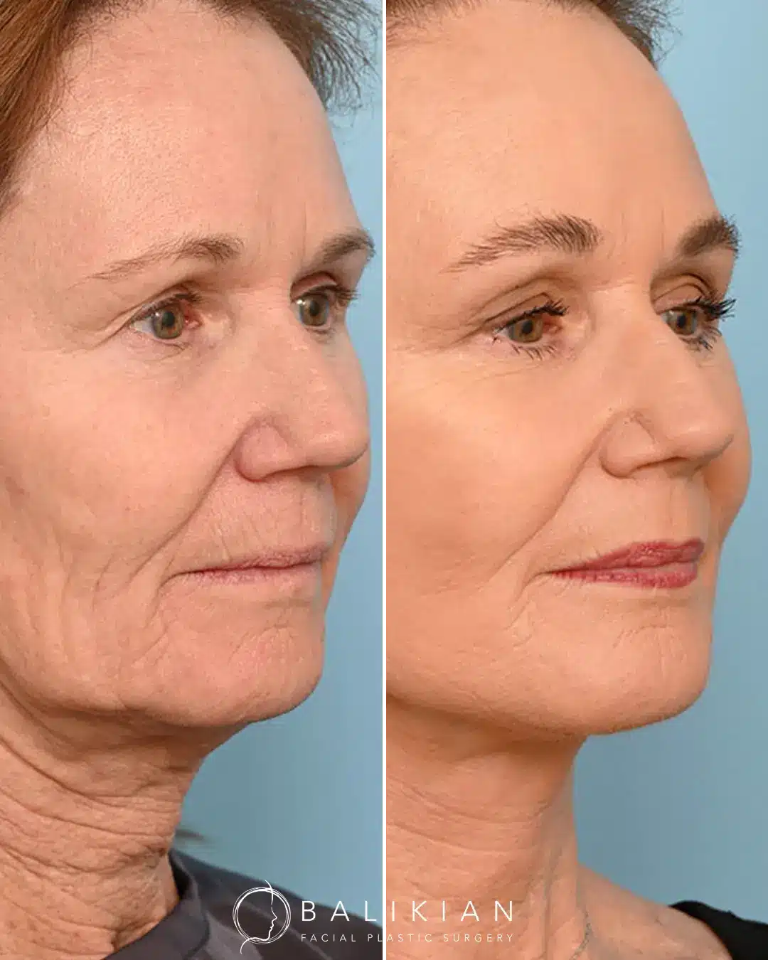 Co2 Ablative Laser Near Me