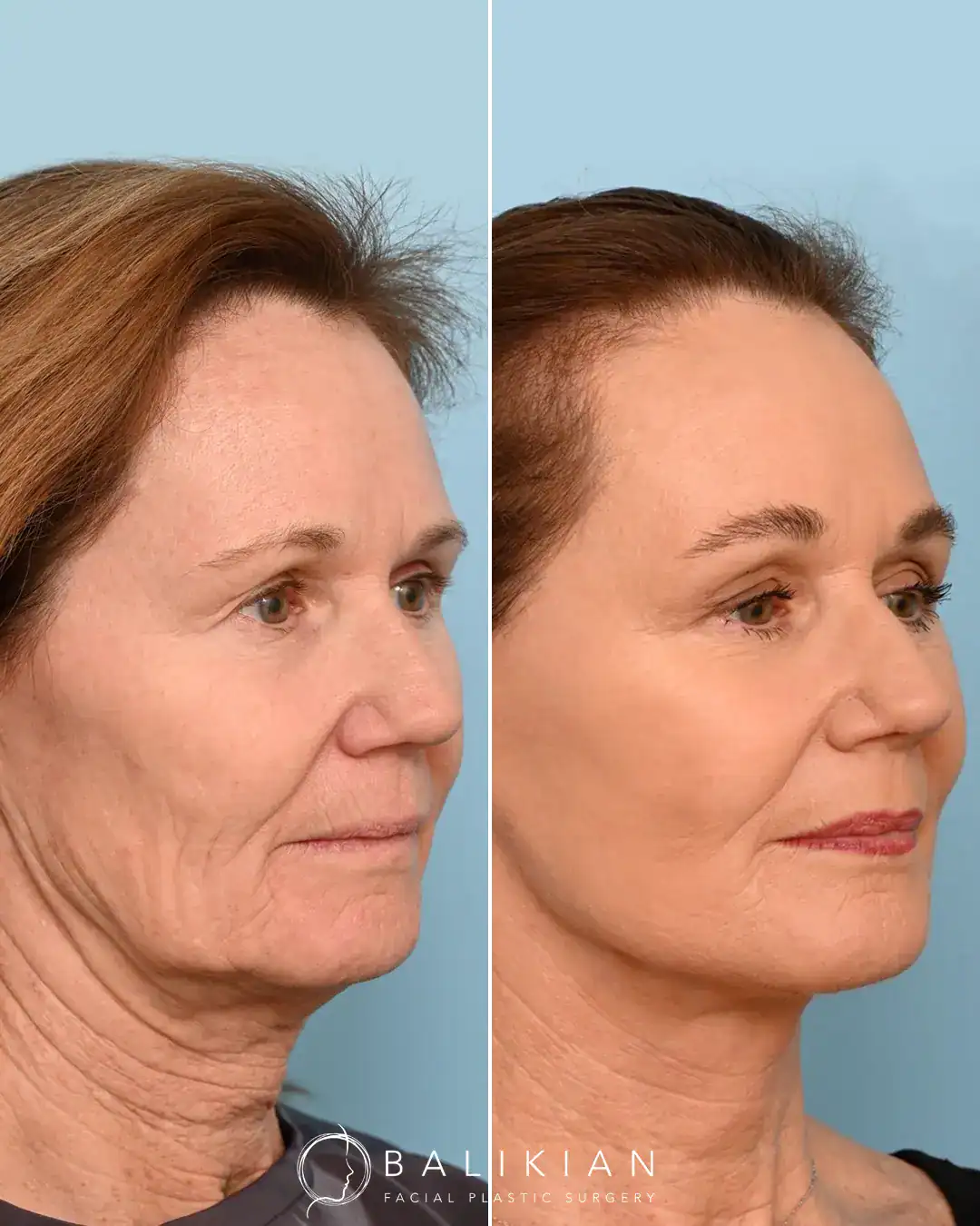 Before and after of deep plane facelift and neck lift showing smoother neck and defined jawline in older woman