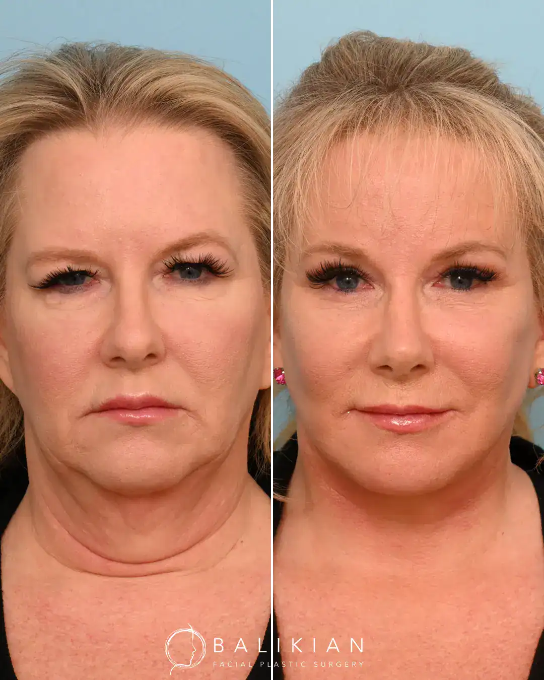 This patient came in and wanted Dr. Balikian’s opinion on what she can do to look her best. Dr. Balikian recommended full facial rejuvenation to lead to the most beautiful result. Oftentimes patients will be scared when multiple procedures are recommended that they are going to look funny or overdone. Dr. Baikian often discusses with his patients that when we treat the 3 ways of aging: gravity, volume loss and texture changes to the skin we will get a more harmonious result. Dr. Balikian is grateful that this patient allowed him to choose the procedures she needed. Her results are beautiful and harmonious even at 3 months. Dr. Balikian performed Deep Plane Facelift with Buccal Fat Excision, Deep Necklift with Subplatysmal Fat Removal, Digastric Muscle Reduction, Submandibular Gland Reduction and Platysmaplasty, Four-Point Minimal Access Brow Lift, Upper Lid Blepharoplasty with Lacrimal Gland Ptosis Repair, Lower Eyelid Transconjunctival Surgery with Skin Pinch, Full Face Fat Transfer and Tip Only Rhinoplasty.