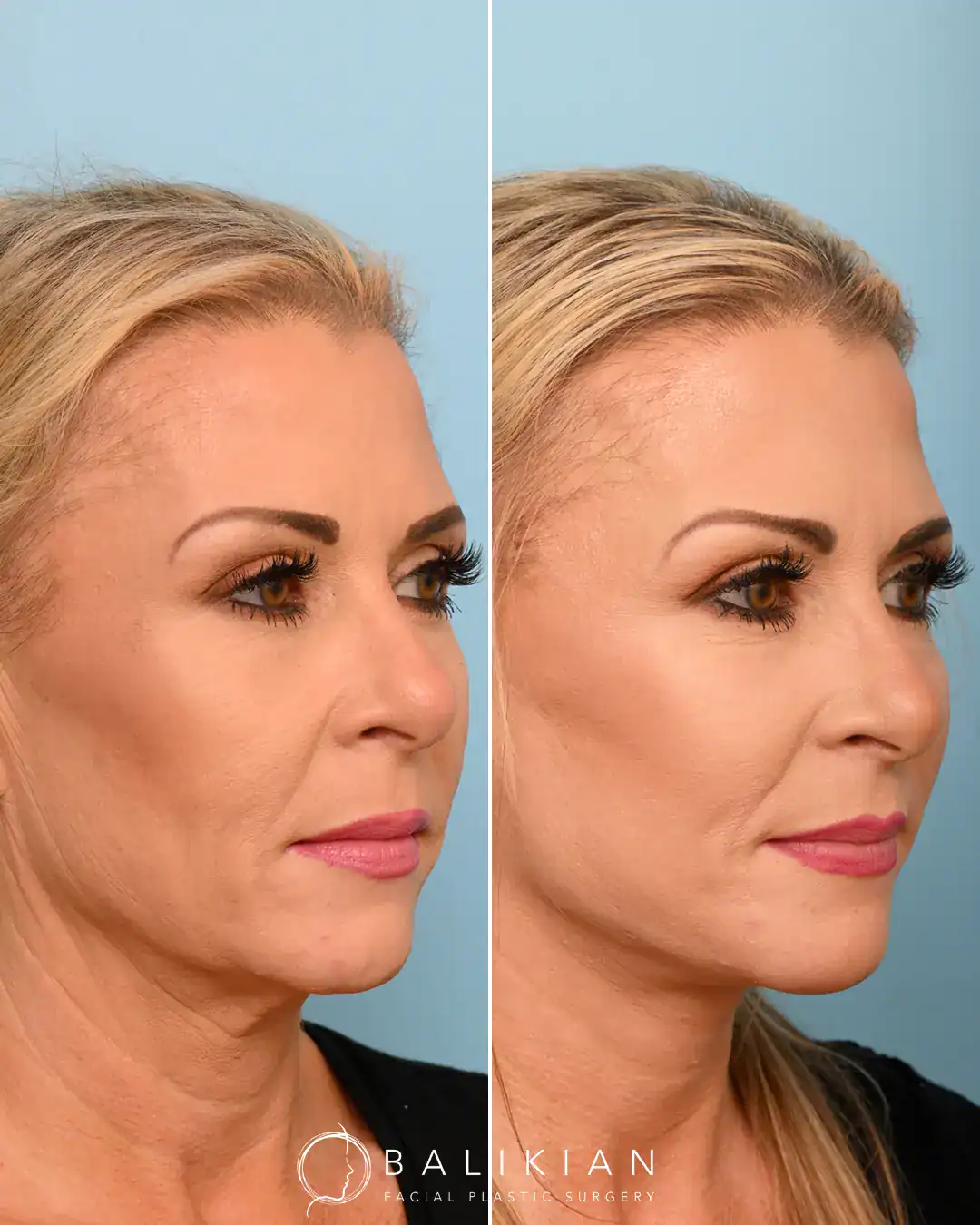 A good facelift can look natural and not tight. This patient wanted to look like herself but get rid of platysmal bands, have a sharper jawline and improve wrinkling around her neck and ear. Dr. Balikian performed an extended Deep Plane Face and Neck lift 1 month ago. Her swelling will continue to heal over time.
