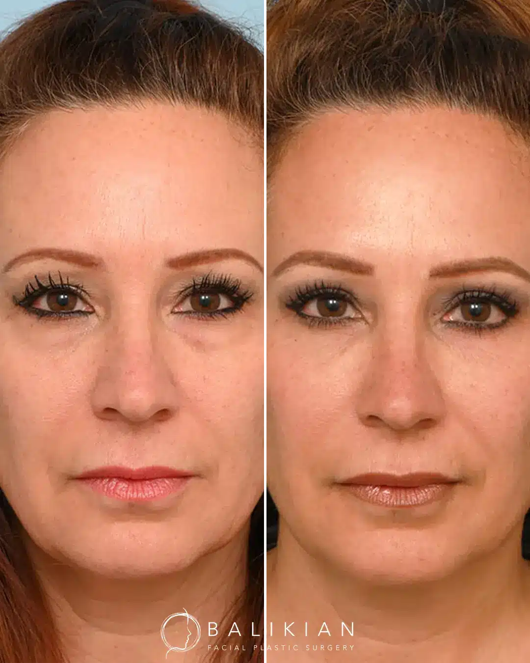 Fat transfer before and after face images highlighting volume restoration