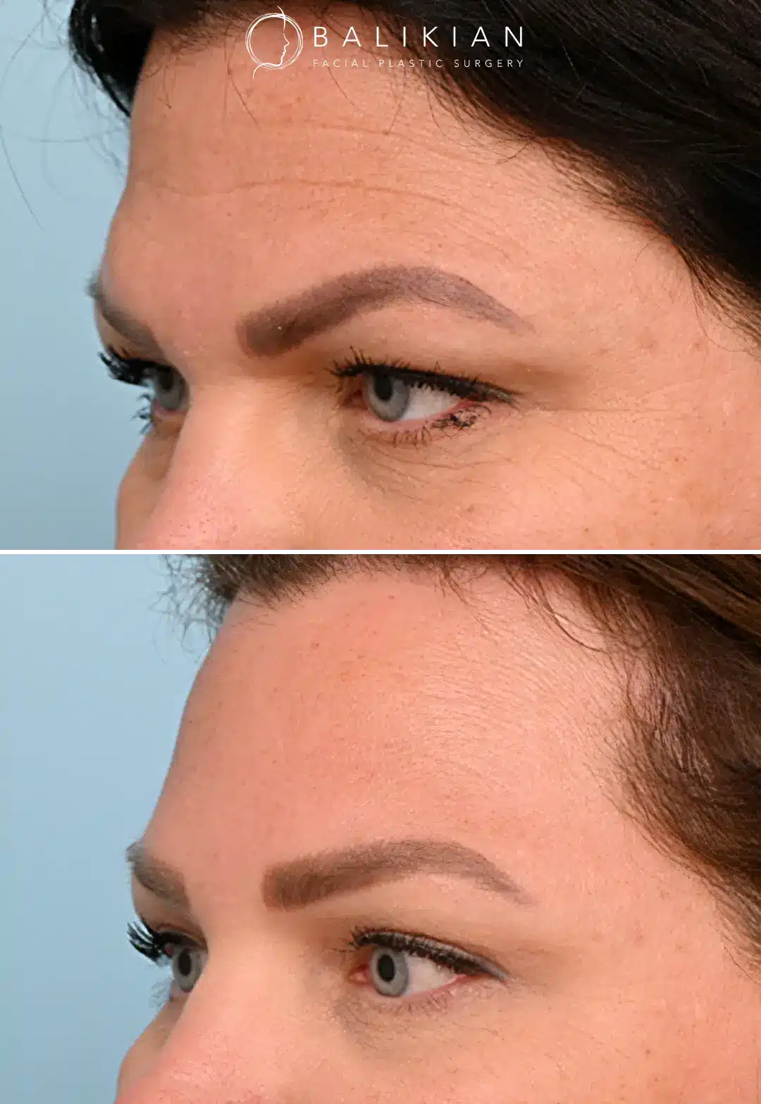 Forehead lift before and after showing restored youthful brow positioning.