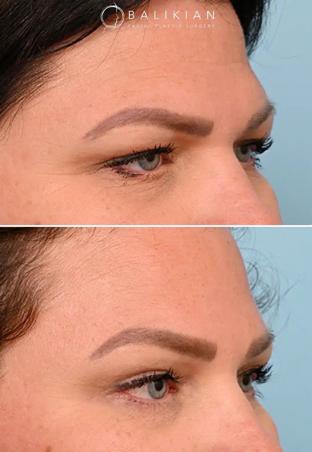 Eyebrow lift before and after with lifted tail of the brow and refreshed upper face.