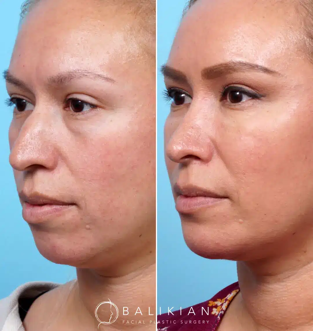 Post-op results from precision neck liposuction