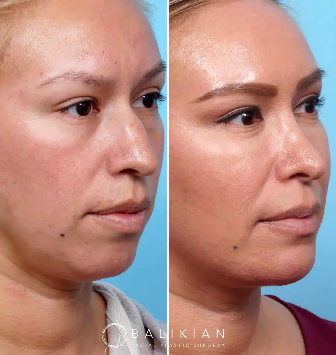 Neck and jaw refinement – liposuction before and after