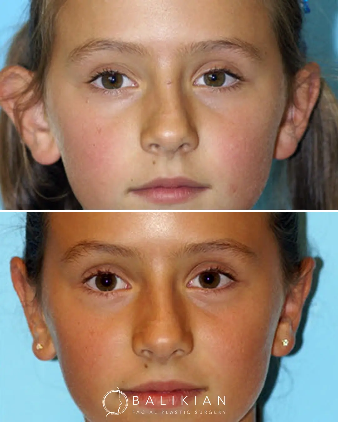 Before and after photo of a patient showing results of otoplasty surgery.