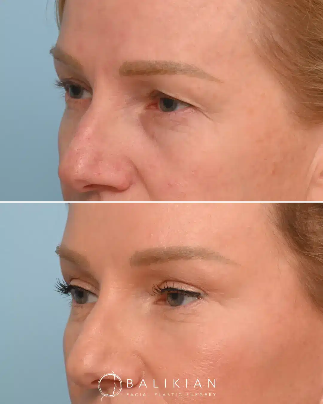 Side-by-side blepharoplasty photos illustrating a refreshed appearance