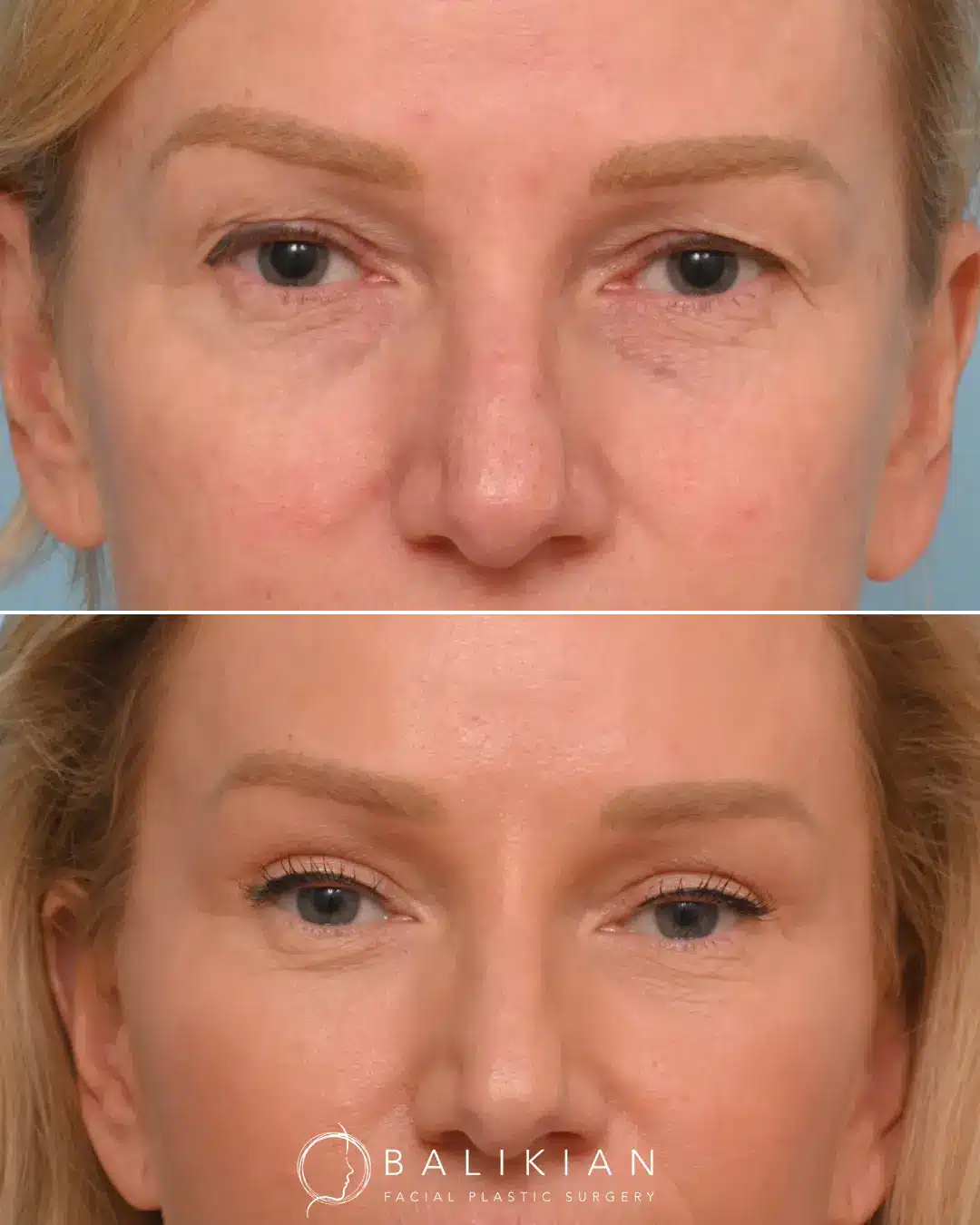 Comparison image showing upper eyelid lift before and after surgery