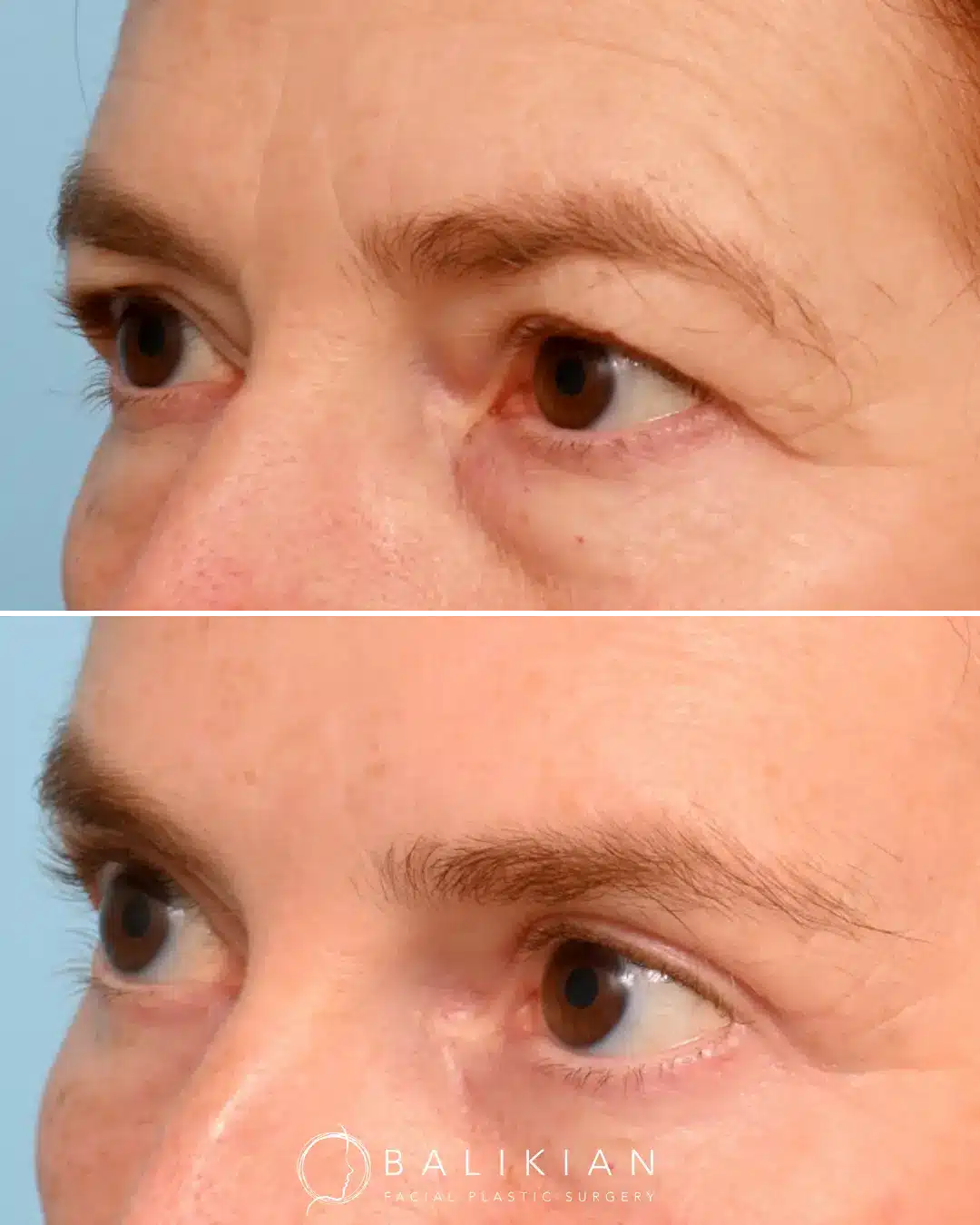 Blepharoplasty results featuring smoother, more youthful eyelids