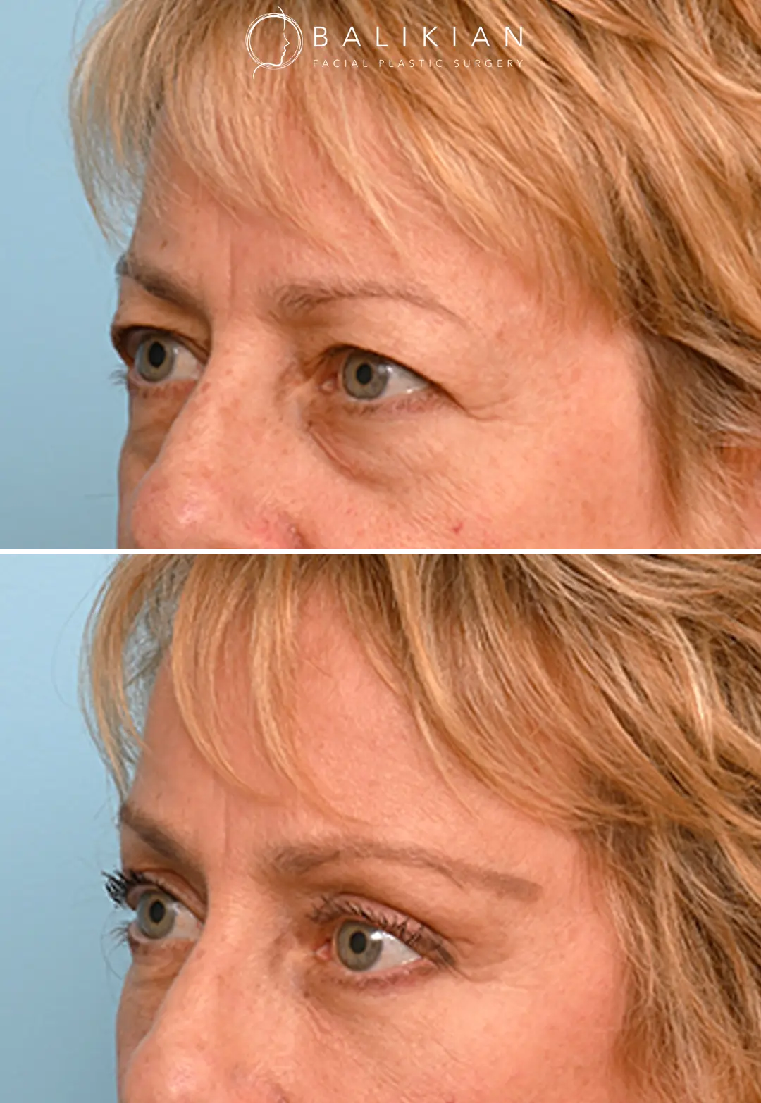Forehead lift before and after side profile showing natural elevation of the brows.