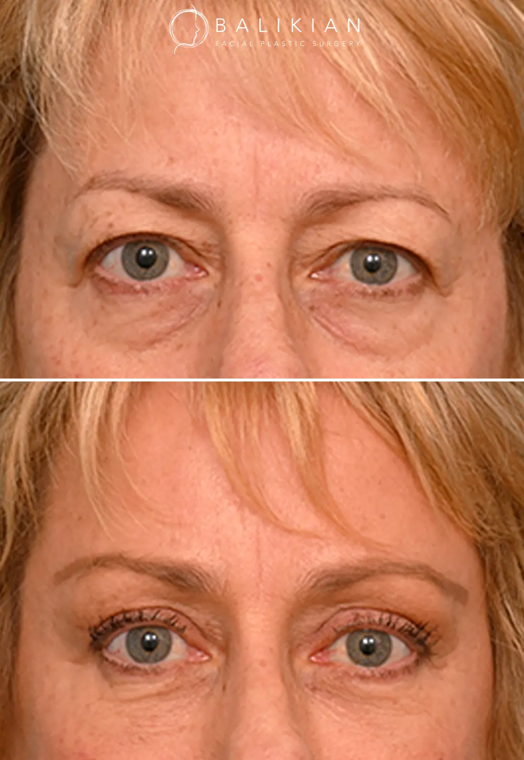 Real patient brow lift before and after with visible reduction in forehead heaviness.