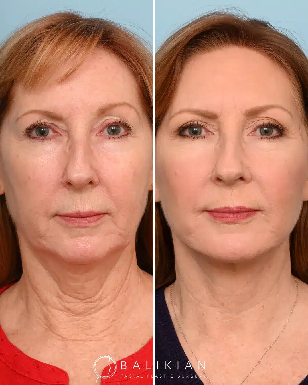 This patient in her 50’s was interested in rejuvenating her face and neck. She was frustrated with her jowls skin laxity and platysmal bands. Therefore Dr. Balikian performed an extended deep plane facelift with deep neck lift to recreate her jawline and give her a defined neck.
