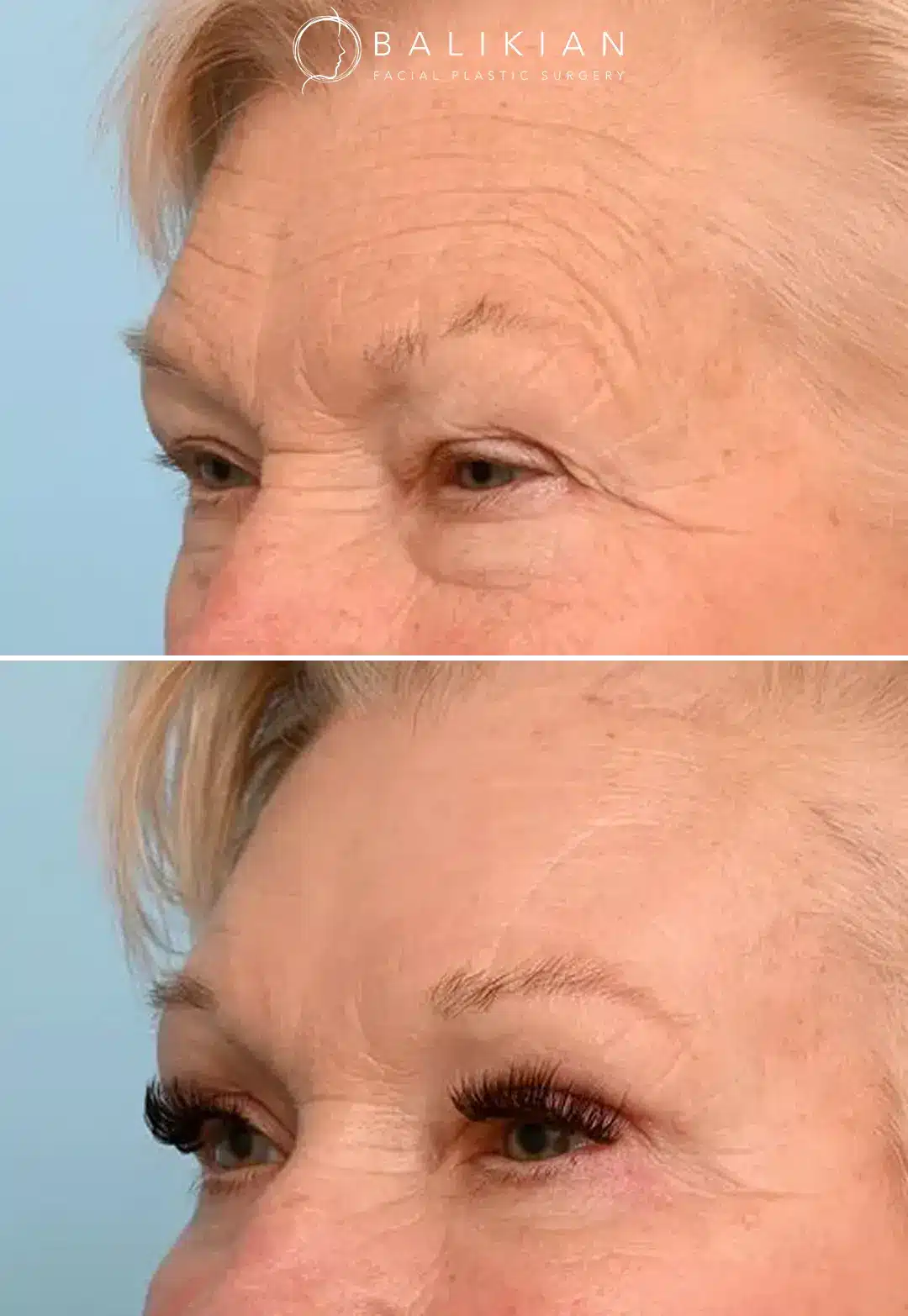 Forehead lift before and after photo highlighting a relaxed and rejuvenated look.