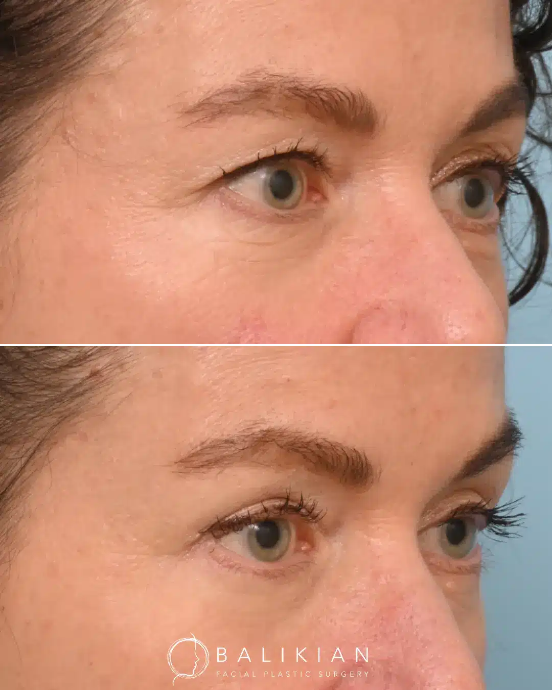 Improved eye area appearance following upper and lower blepharoplasty