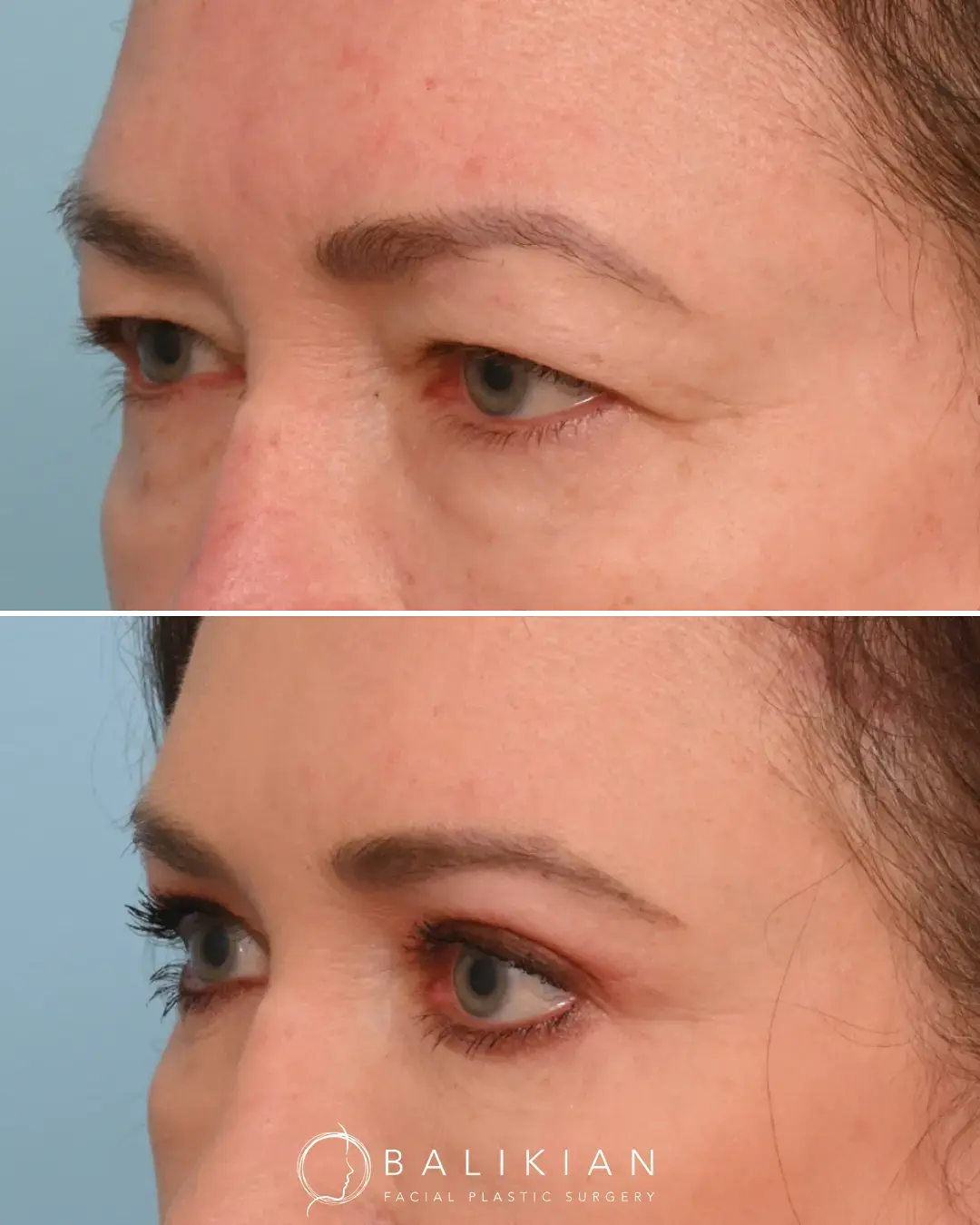Before and after images of surgical correction for droopy eyelids