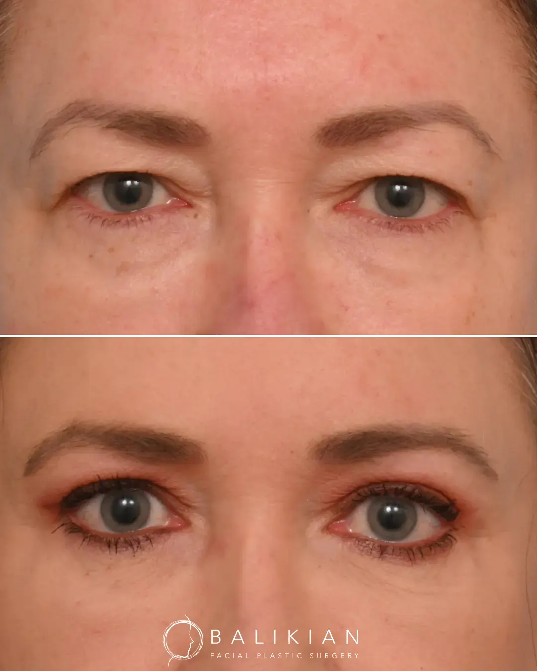 Visual comparison of pre- and post-surgery eyelid rejuvenation