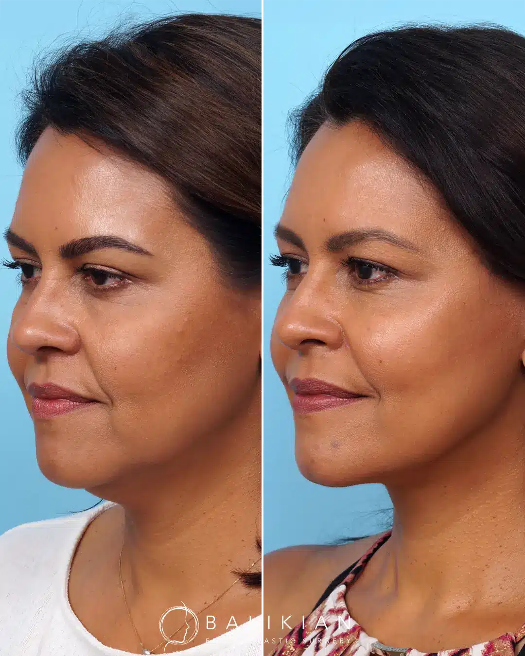 This patient in her late 40’s wanted a refreshed look. Dr. Balikian performed a facelift and full face fat transfer a year ago. Often times a facelift can rejuvenate and prevent premature aging even in your late 40’s.