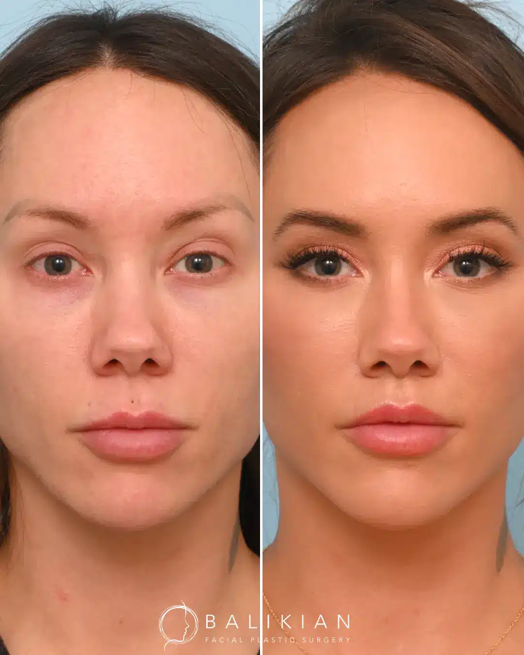 This front-facing comparison shows how the lip lift subtly enhanced the upper lip’s shape and volume, creating a more defined Cupid’s bow and a youthful, proportionate look.