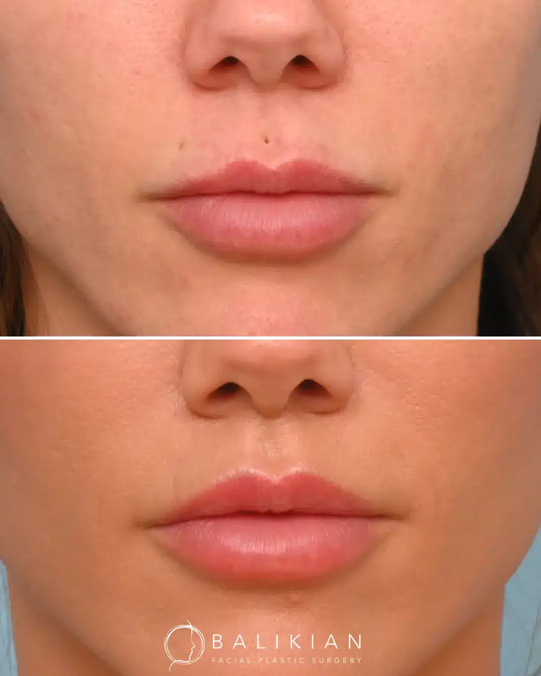 A close-up of the lips reveals increased vertical height and improved upper lip definition after the lift, giving the lips a fuller, more sculpted appearance while preserving a natural texture.