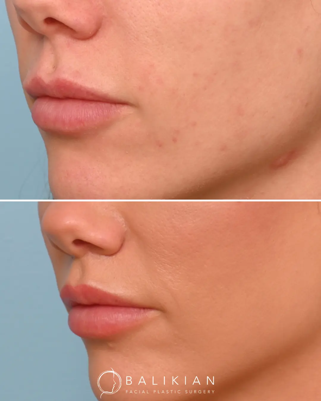 Seen from the side, the lip lift creates a gentle upward rotation of the upper lip, improving balance between the nose, lips, and chin with results that look effortless and refined.