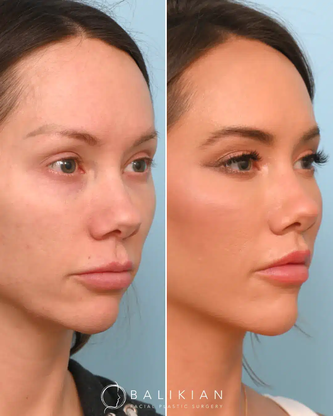 In this view, the refined upper lip contour adds soft volume and enhances overall facial harmony, delivering a confident, refreshed expression that still looks authentically her.