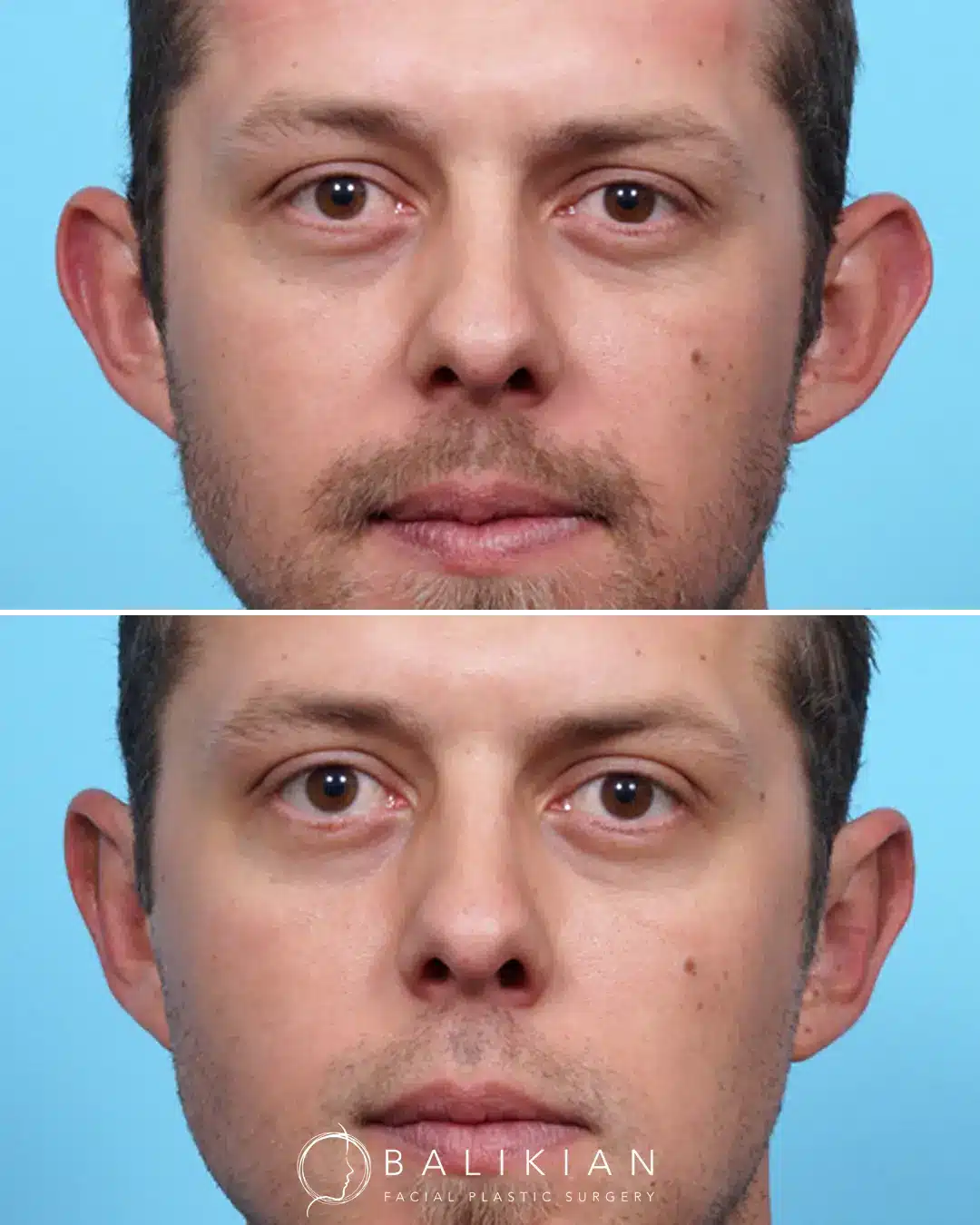 Before and after photo of a patient showing results of otoplasty surgery.