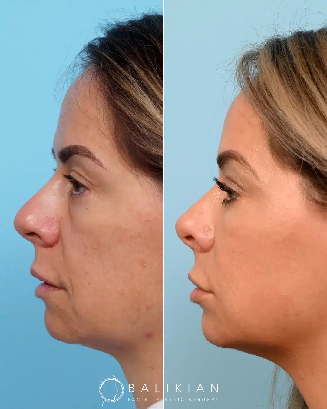Before and after revision rhinoplasty showing refined nasal tip and improved profile