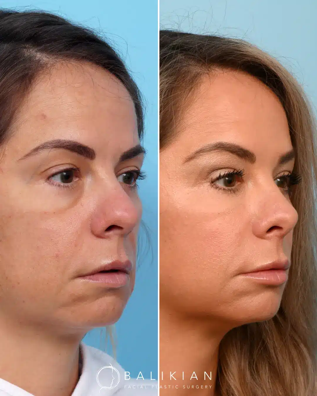 Natural-looking outcome after tip-focused revision rhinoplasty