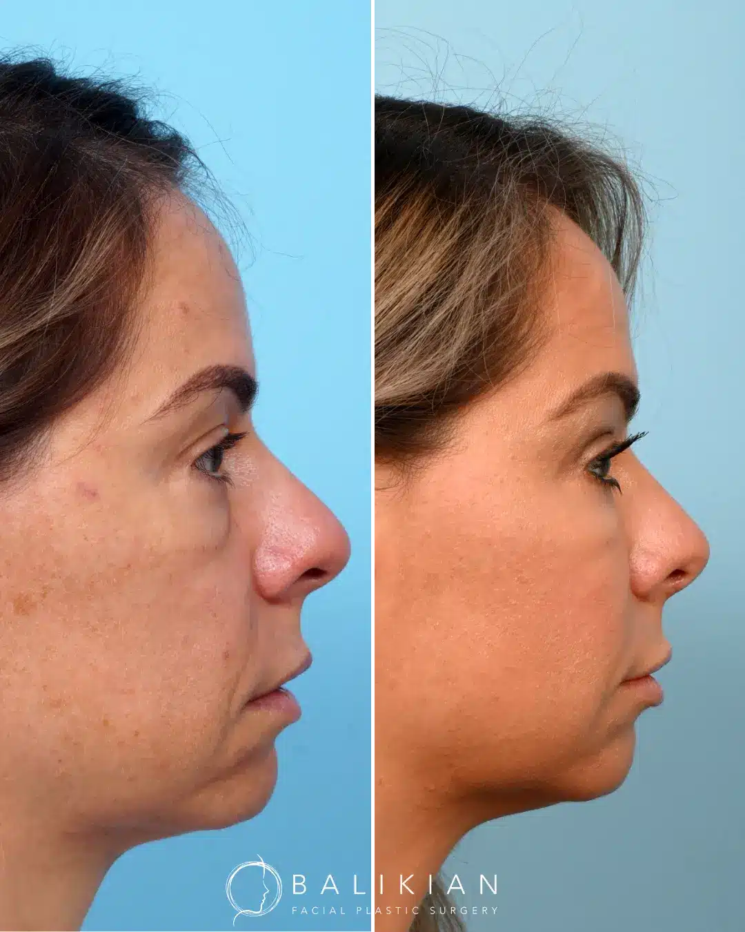 Profile photo of patient after revision rhinoplasty with improved nasal definition
