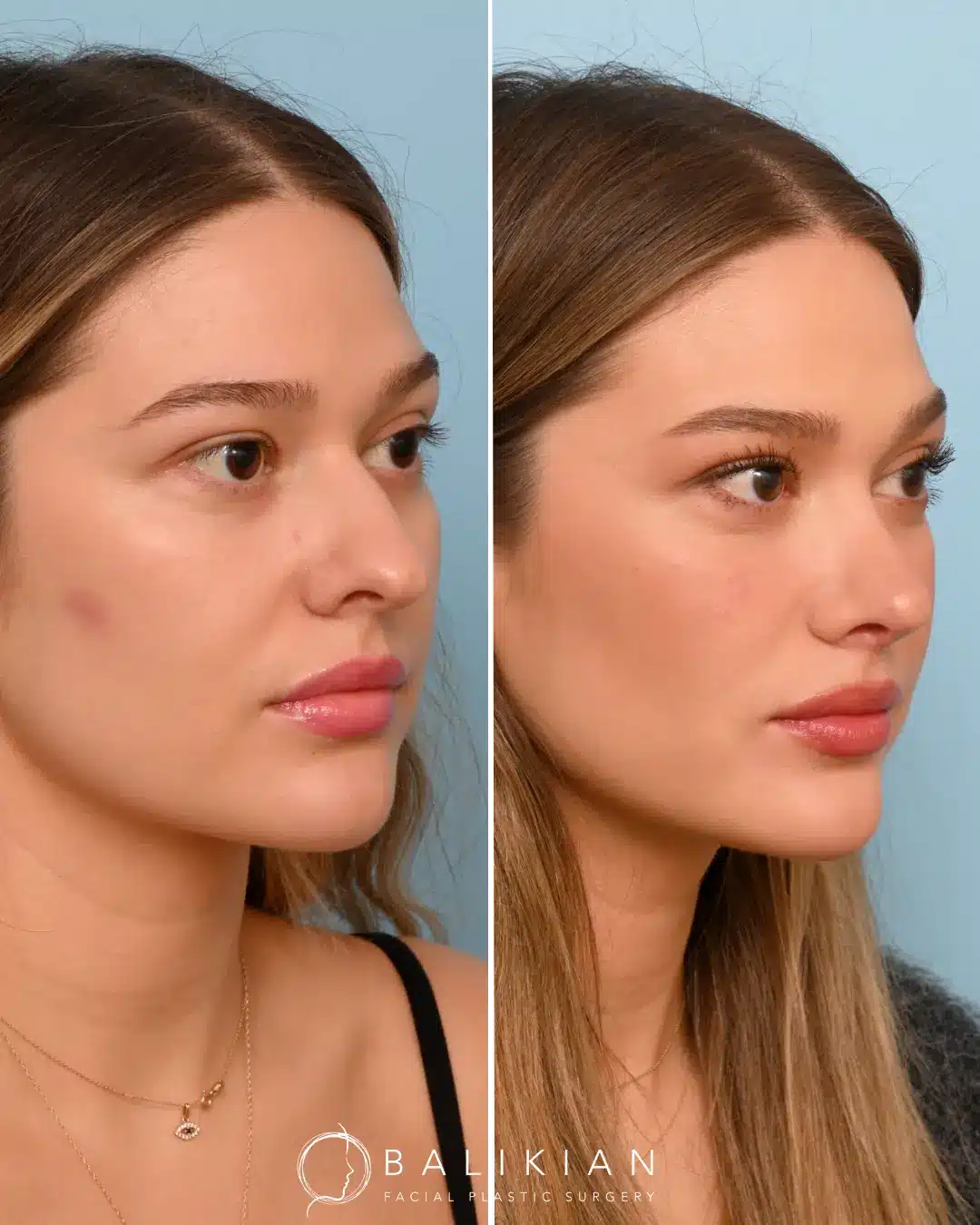This 26-year-old patient sought rhinoplasty to refine the shape of her nose and achieve better facial harmony. Her primary concerns included a prominent dorsal hump and mild asymmetry that affected her profile and self-confidence.