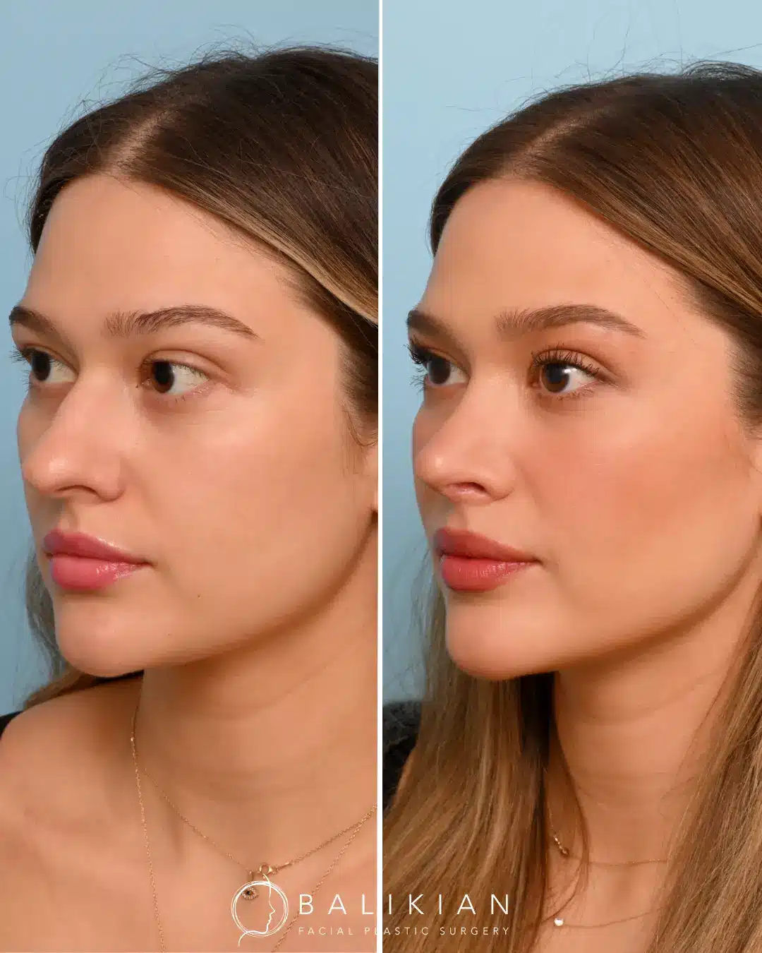 Before: The patient’s nasal bridge displayed a noticeable hump with slight bulbosity at the tip, contributing to a stronger profile than desired. Front-facing views also revealed minor deviations that impacted facial symmetry.