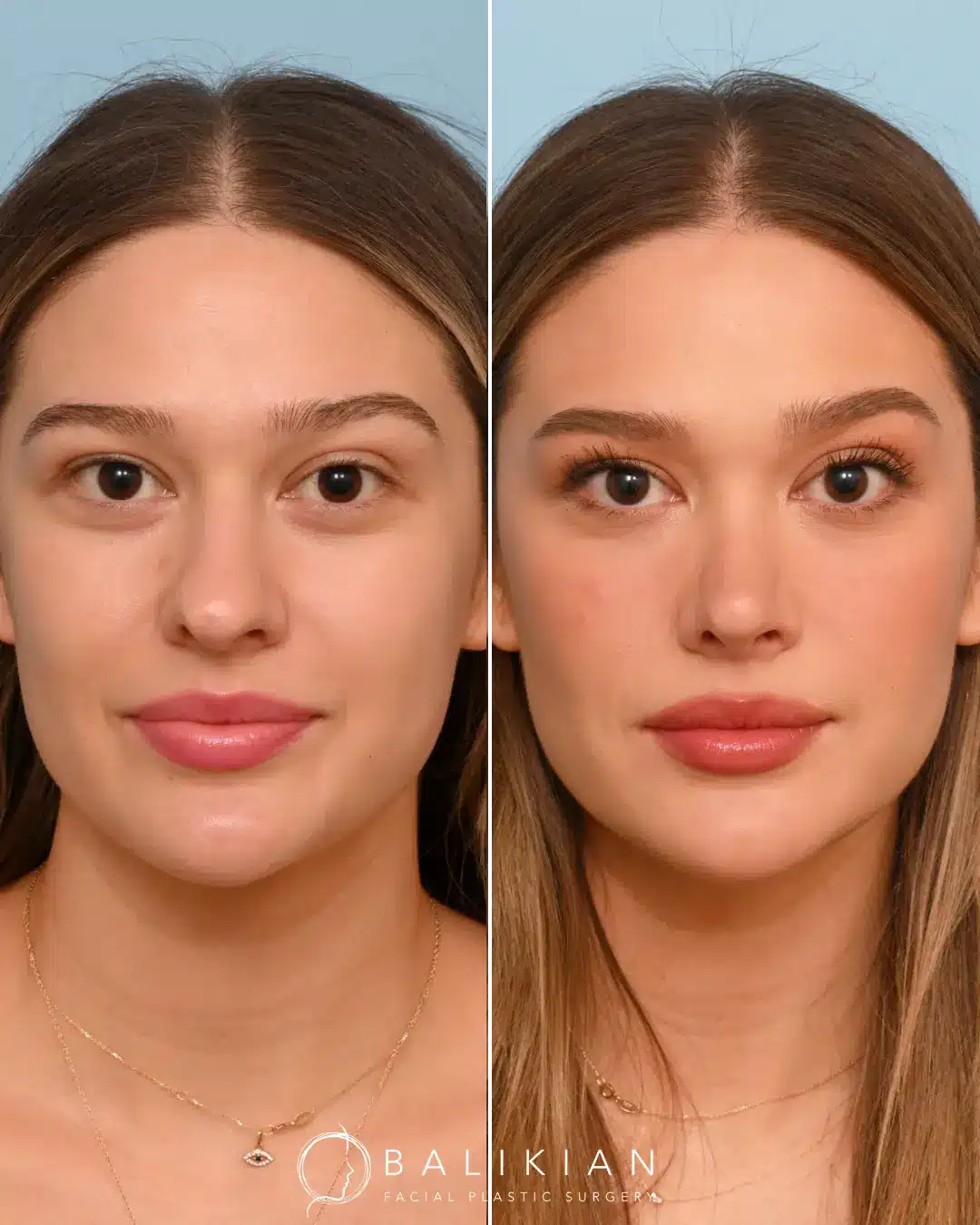 After: Following a successful rhinoplasty, the patient’s nose now features a smooth, natural-looking bridge with a refined tip. The results enhance her overall facial balance while preserving her unique features. The outcome is both subtle and transformative, boosting her confidence and comfort in her appearance.