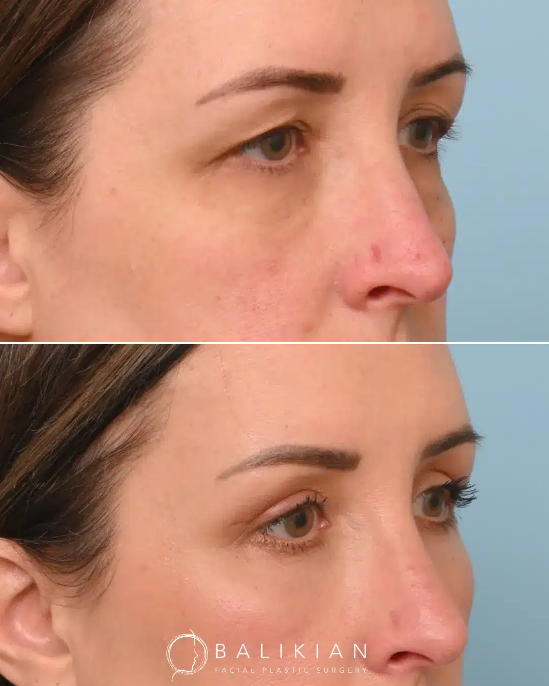 Cosmetic eyelid surgery results showing restored eye definition