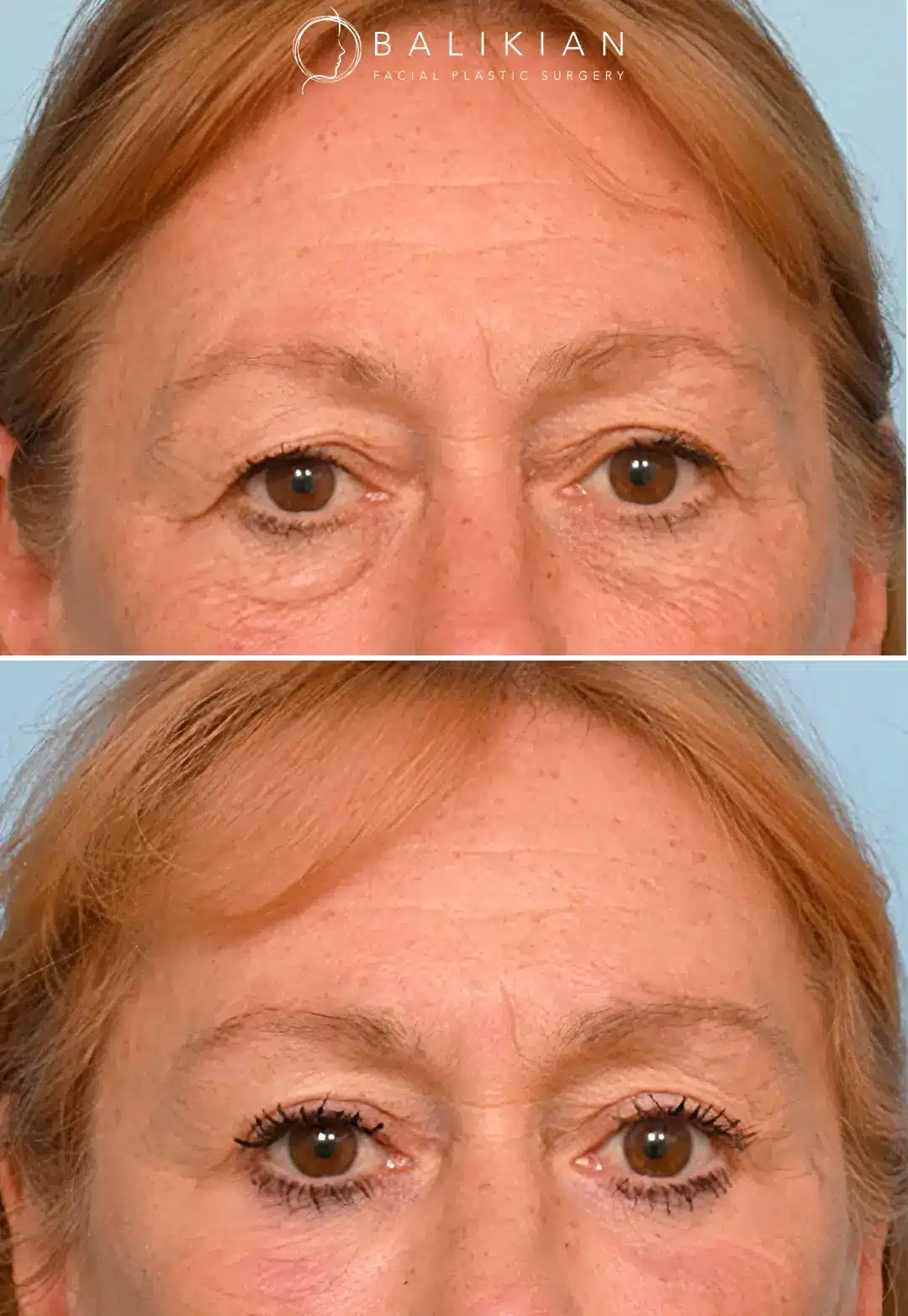Eyebrow lift before and after showing brighter, more alert appearance.