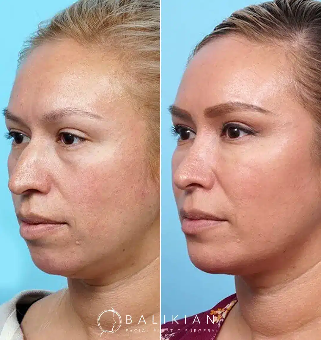 Profile transformation following cosmetic chin enhancement surgery