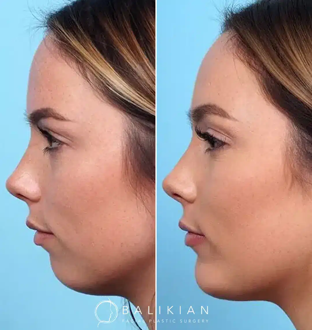 Chin implant results highlighting a stronger, more defined profile