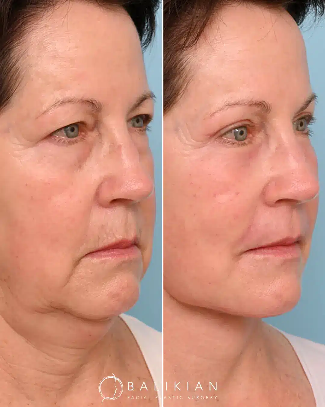 Skin transformation showing reduced pores and smoother surface after CO2 laser resurfacing