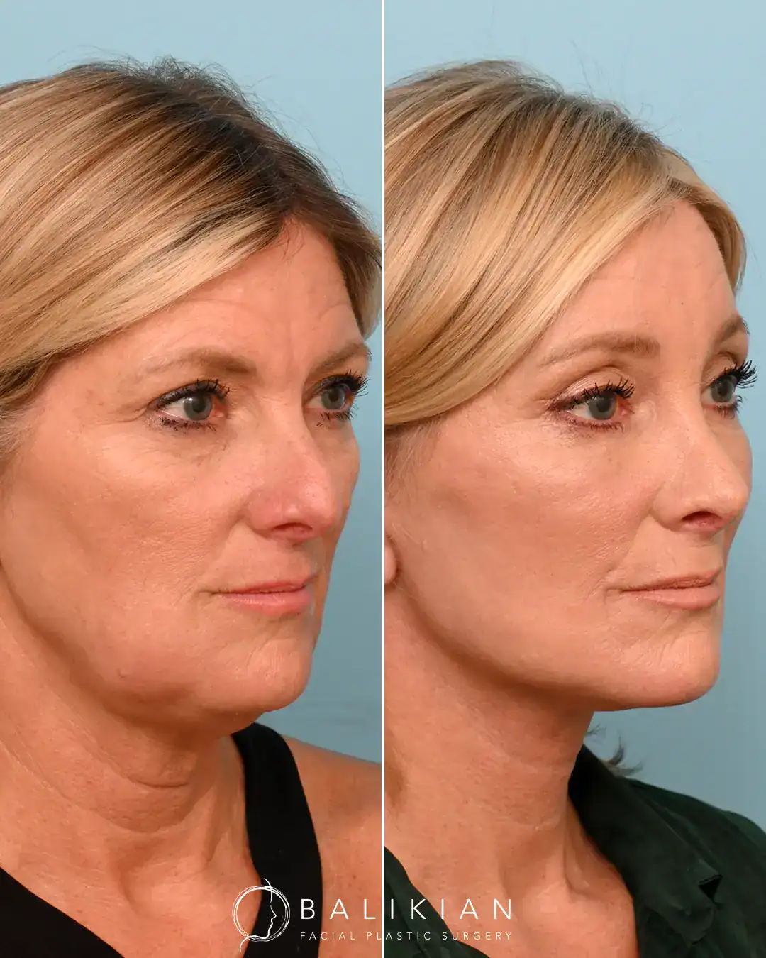 This patient in her mid-50’s shares how her facial rejuvenation helped reverse the aging that comes along with cancer. Dr. Balikian performed a Deep Plane Facelift with Deep Necklift, Upper Blepharoplasty, Lower Eyelid Skin Pinch, Rhinoplasty, Facial Fat Transfer and 4 Point Brow Lift.