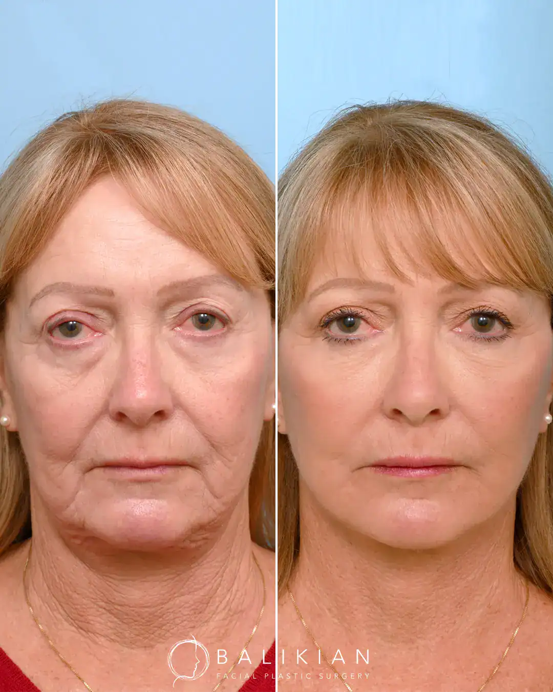 This patient in her 60’s wanted a more refreshed look. So, Dr. Balikian performed a face and neck lift with fat transfer and a lower transconjunctival blepharoplasty.