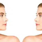 Side-by-side comparison of a woman before and after rhinoplasty, highlighting nasal contour improvement with dashed lines on the pre-operative profile.