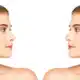 Side-by-side comparison of a woman before and after rhinoplasty, highlighting nasal contour improvement with dashed lines on the pre-operative profile.