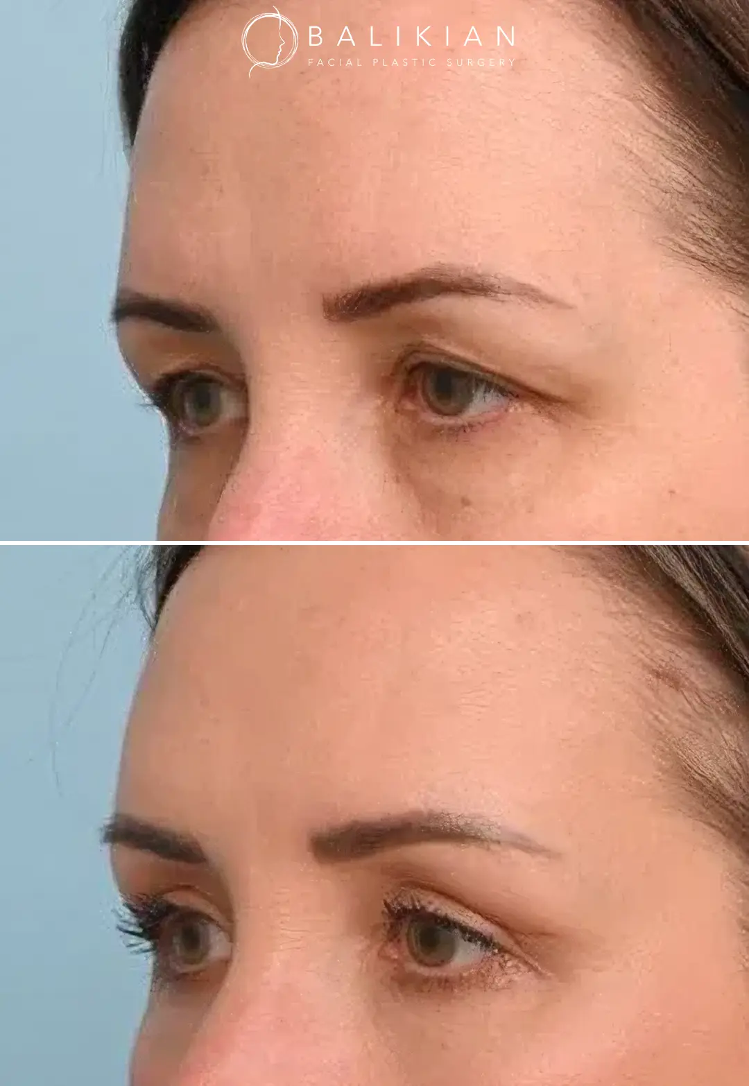 Natural brow lift before and after transformation with enhanced eye openness.