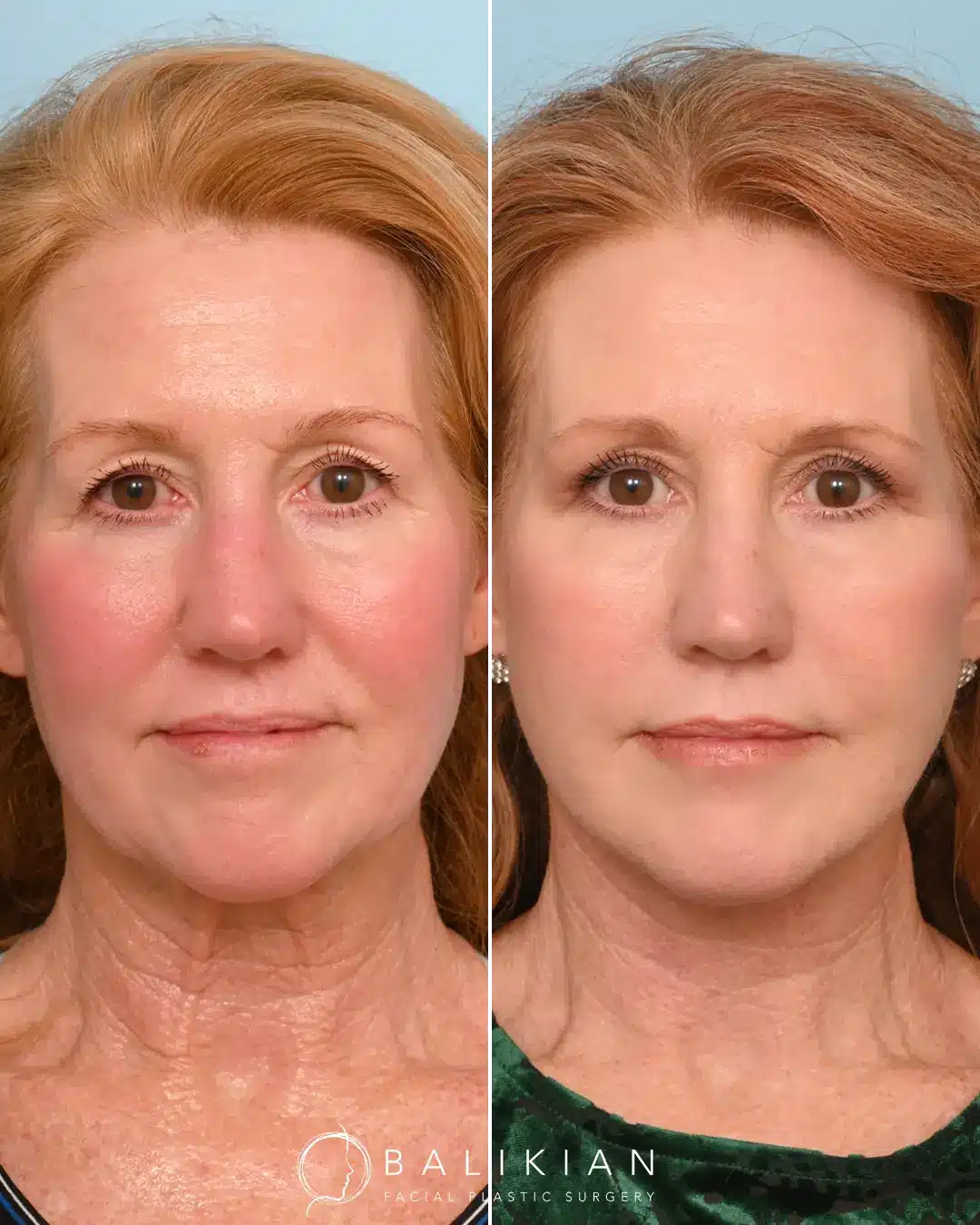 Dr. Balikian performed and Extended Deep Plane Face & Neck Lift with Fat Transfer, Temporal Browlift & Upper Blepharoplasty 3 months ago to give her a naturally refreshed look.