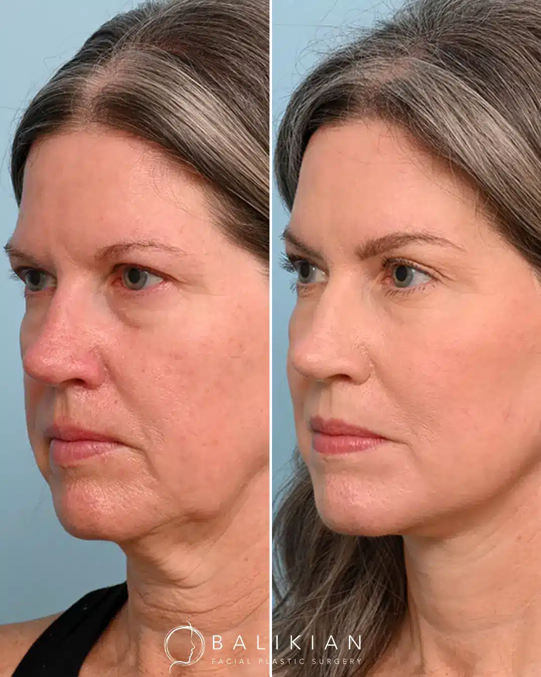Facial fat transfer results showing softened hollow temples