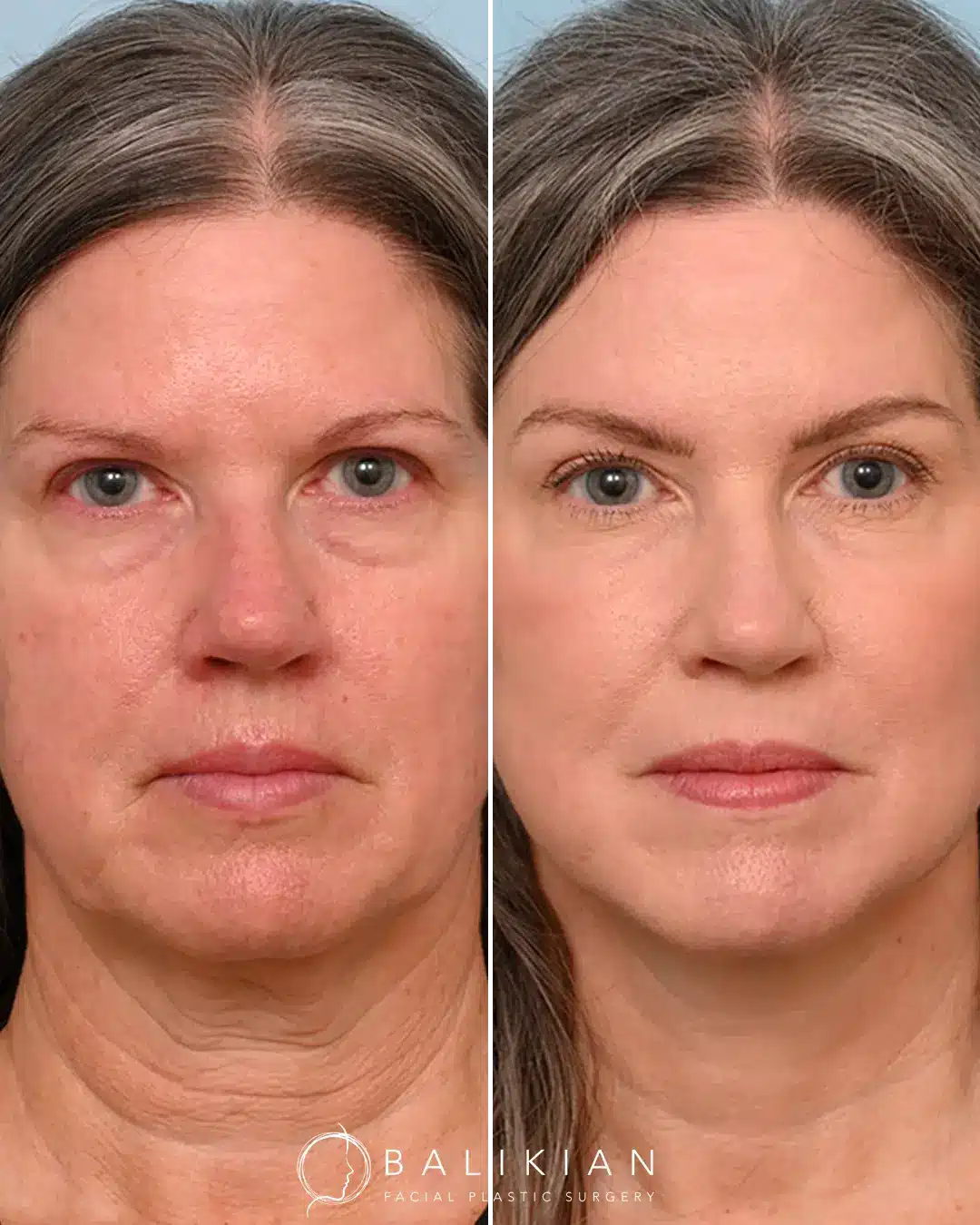 Fat injections in face before and after improving tired appearance
