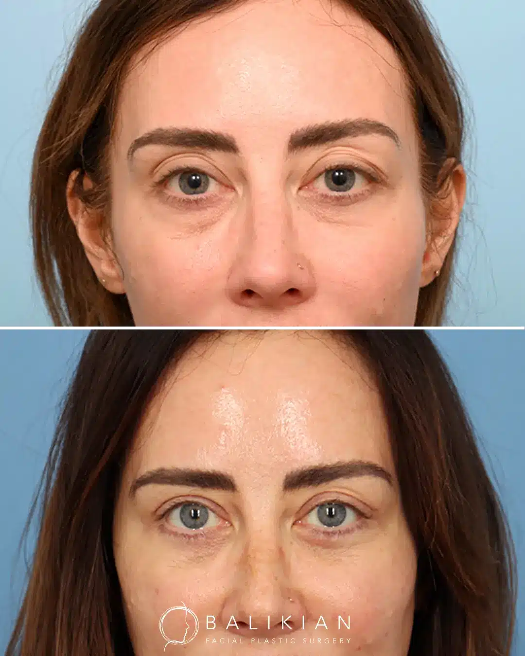Subtle rejuvenation from facial fat transfer before and after images