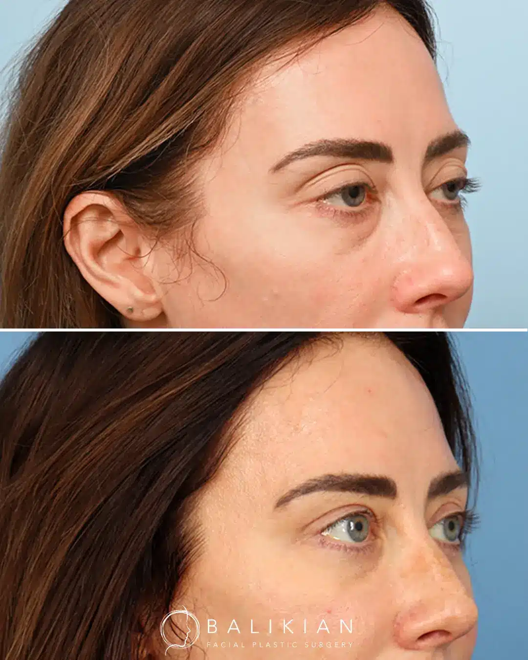 Natural results shown in fat injections in the face before and after
