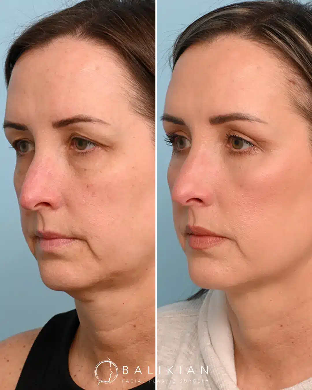 Fat transfer to face before and after showing natural cheek lift