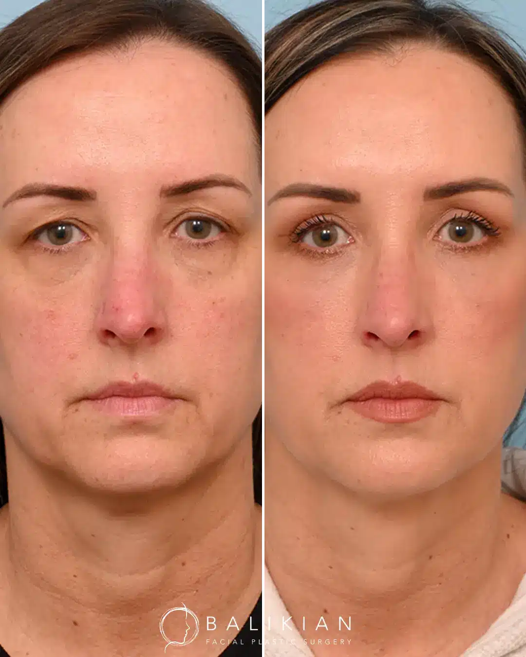 Volume restoration through facial fat grafting before and after examples