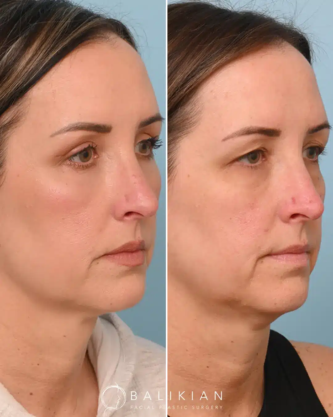 Fat injections in face before and after featuring under-eye improvement
